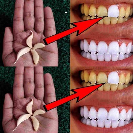 Come sbiancare i denti con l’aglio?
