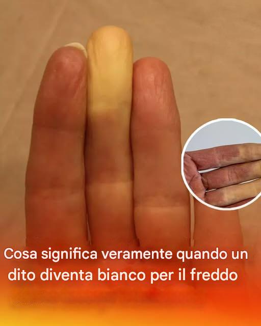 Cosa significa veramente quando un dito diventa bianco quando fa freddo