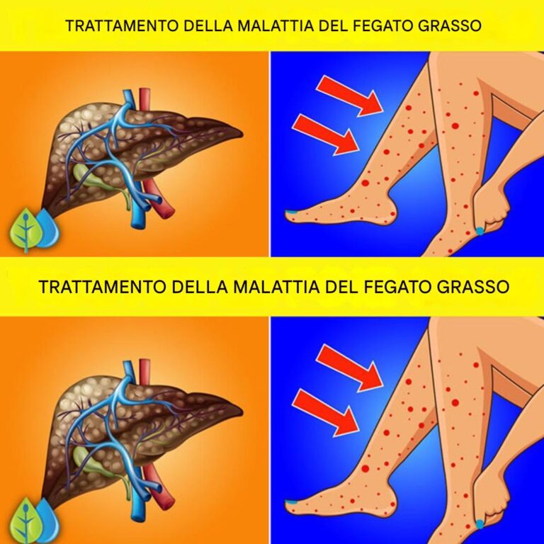 7 segni e sintomi della steatosi epatica e come trattarla in modo naturale