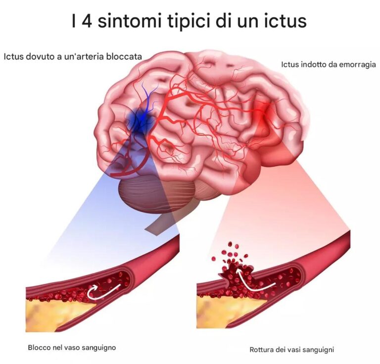 I 4 sintomi tipici di un ictus