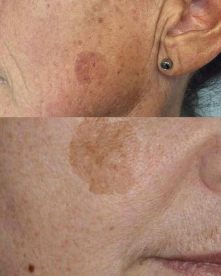 Hai mai provato a schiarire le macchie scure del viso con i rimedi naturali?