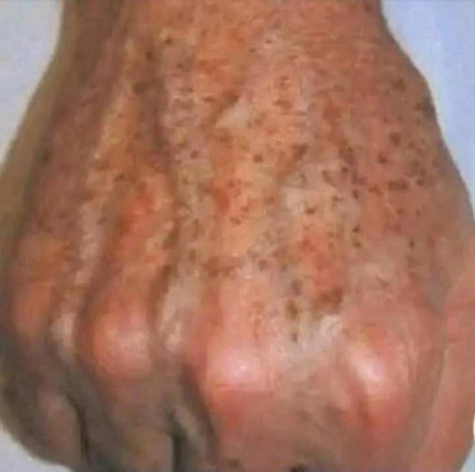 Saviez-vous que si des taches apparaissent sur vos mains, c’est un signe clair que Qui n’a jamais soupiré devant le miroir, découvrant une nouvelle tache ou une ride plus marquée ? Voilà à quoi ressemble la vie quotidienne de nombreuses femmes. Cause? Des facteurs bien connus : le temps qui passe, bien sûr, mais aussi notre rythme de vie effréné, le stress, une alimentation parfois déséquilibrée et surtout notre meilleur faux ami : le soleil. L’exposition aux rayons UV fragilise la peau en profondeur, accélérant la perte de collagène et d’élasticité. Résultat : la peau devient plus fine, moins ferme, et des irrégularités de pigmentation peuvent apparaître, comme les fameuses taches brunes. Heureusement, il n’est jamais trop tard pour prendre soin de votre peau et lui redonner son éclat naturel. Pourquoi ces taches apparaissent-elles ? Les taches qui apparaissent sur les mains, notamment avec l’âge, sont souvent appelées taches brunes ou taches de vieillesse. En fait, leur vrai nom est lentilles solaires. Elles sont principalement causées par une exposition répétée au soleil au fil des années. C’est comme si la peau se souvenait de chaque rayon UV qu’elle reçoit… et après un certain temps, elle le montre.