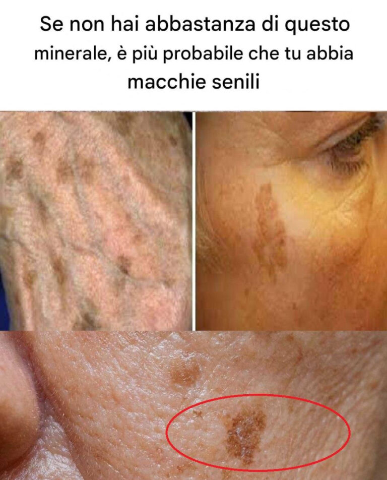 Se non hai abbastanza di questo minerale, è più probabile che tu abbia macchie senili