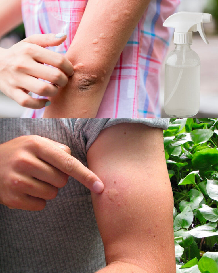 Come Alleviare il Prurito delle Punture di Zanzara (con un solo ingrediente!)