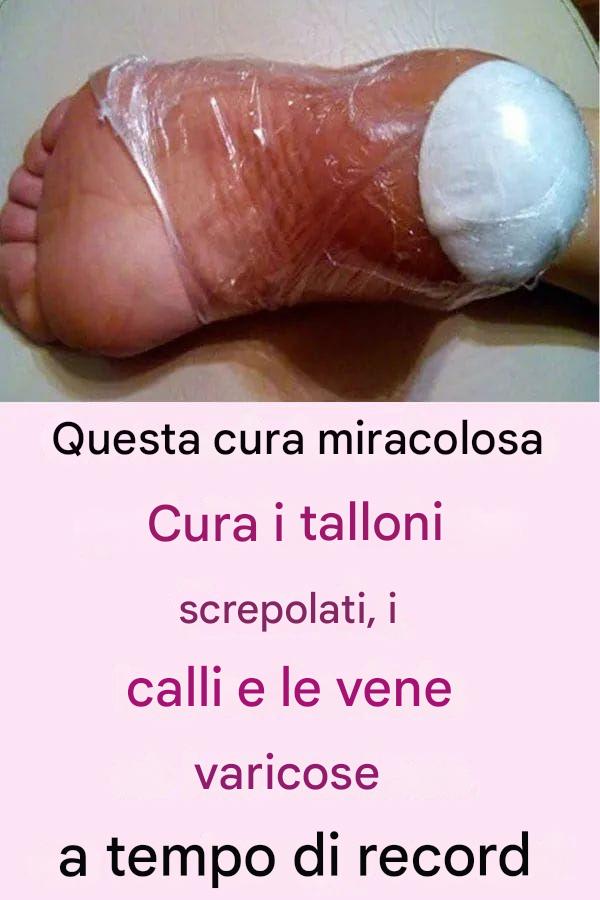 Elimina i talloni screpolati, i calli e i duroni con questo rimedio casalingo