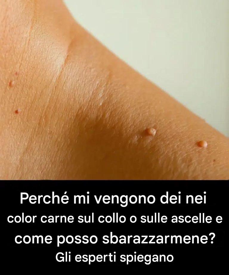 Perché mi compaiono nei color carne sul collo o sulle ascelle e come posso sbarazzarmene? Ce lo spiegano gli esperti
