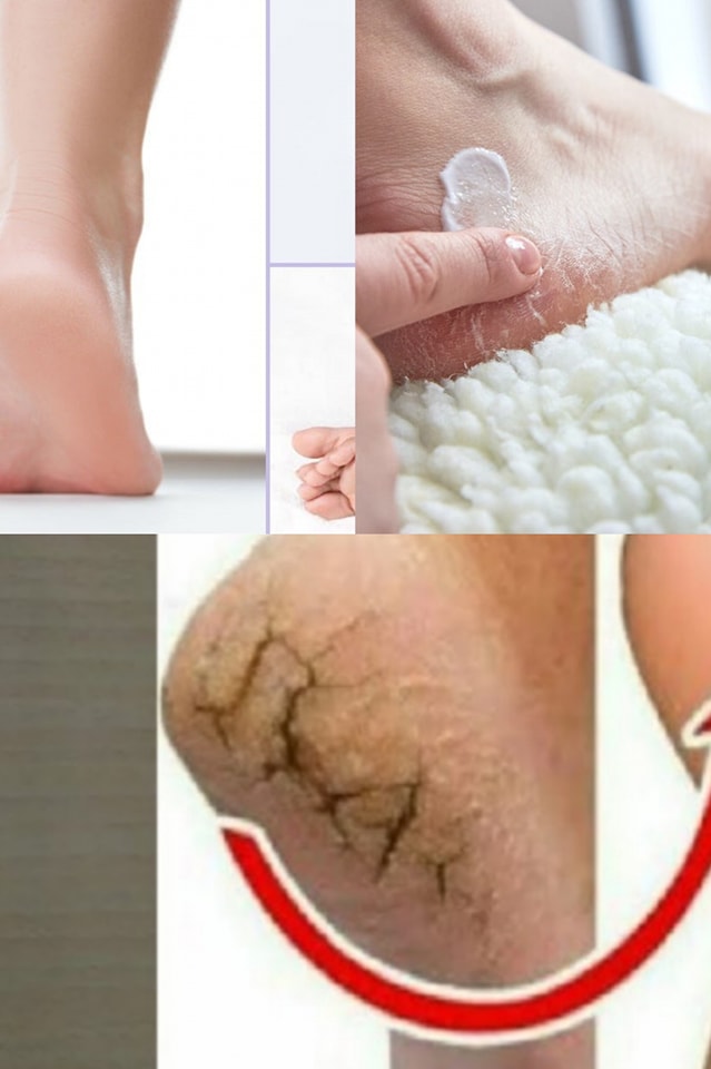 Questo trucco naturale ti aiuta a combattere i talloni screpolati durante la notte!