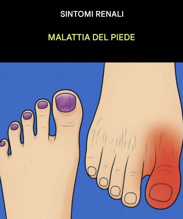 Cosa dicono i tuoi piedi sui tuoi reni