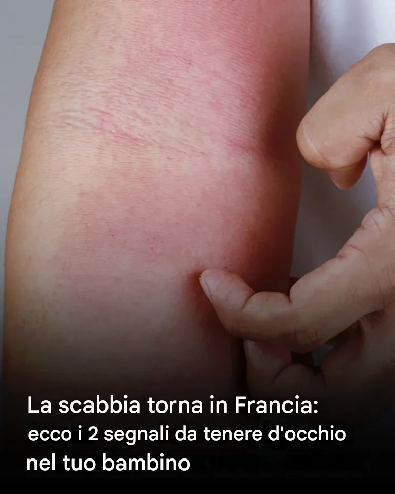 La recrudescenza di una malattia della pelle in Francia: riconoscere i sintomi nei bambini