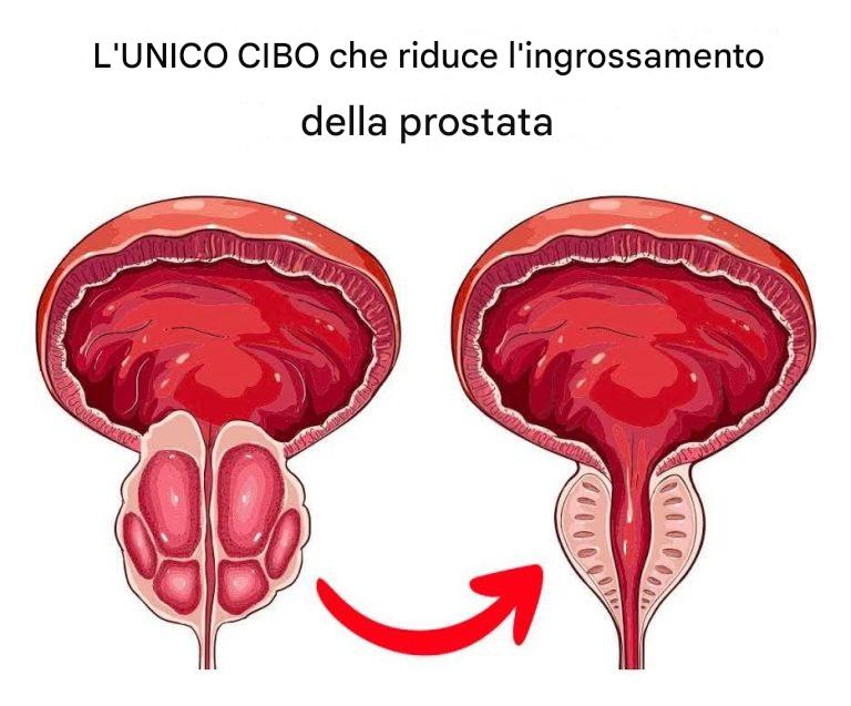 Alimenti che riducono l'ingrossamento della prostata